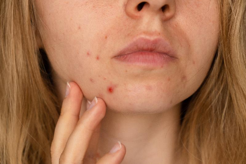 cbd-e-acne